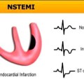 NSTEMI 5c9a8e4b3033a3bb39886b7542ad1228