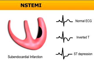ΣΕ ΕΜΦΡΑΓΜΑ NSTEMI (ΧΑΜΗΛΟΥ- ΜΕΤΡΙΟΥ ΚΙΝΔΥΝΟΥ) ΘΑ ΓΙΝΕΤΑΙ ΑΡΧΙΚΑ ΑΞΟΝΙΚΗ ΣΤΕΦΑΝΙΟΓΡΑΦΙΑ ?