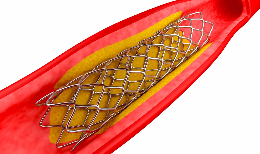 ΤΑ ΕΠΕΙΣΟΔΙΑ ΜΕΤΑ ΑΠΟ ΤΟΠΟΘΕΤΗΣΗ STENT