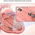 leadless-pacemaker-and-subcutaneous-icd-54-638