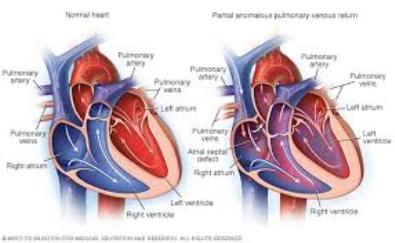 PAPVR Partial anomalous pulmonary venous returnαρχείο λήψης