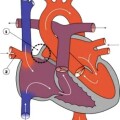 papvr Partial_Anomalous_Pulmonary_Venous_Drainage