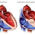 hcm a-medical-illustration-of-a-normal-heart-and-one-with-hypertrophic-cardiomyopathy-original-1024x695