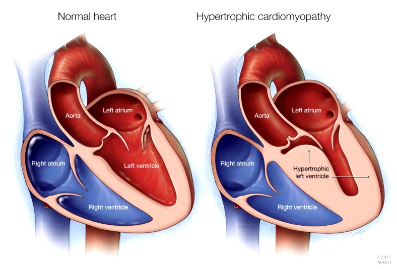 Η ΥΠΕΡΤΡΟΦΙΚΗ ΜΥΟΚΑΡΔΙΟΠΑΘΕΙΑ (HCM)