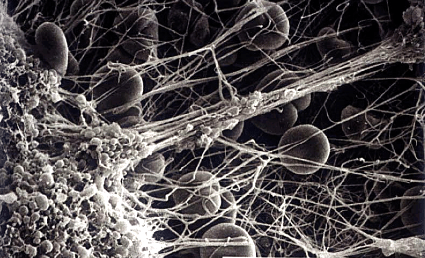 coag Scanning-electron-micrograph-of-platelet-rich-thrombus-interacting-with-fibrin-strands