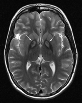 panto Typical-brain-MRI-in-a-patient-with-PKAN-showing-eye-of-the-tiger-sign-central