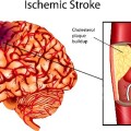 homo 13699566-brain-stroke-a-illustration-of-ischemic-stroke-