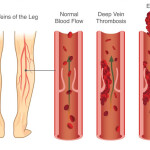 thromb What-Is-Deep-Vein-Thrombosis
