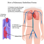 Pulmonary-Embolism