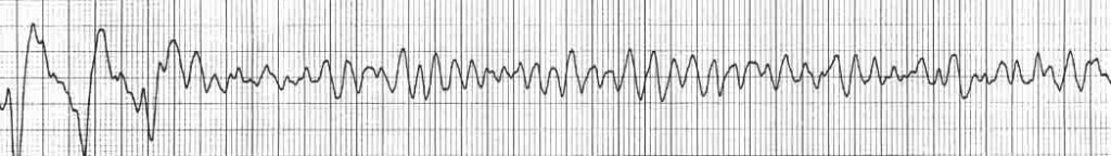 arr ventricular-fibrillation-rhythm-strip-VF-shock-advised