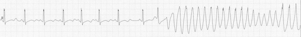 hypo ECG-severe-hypokalemia-serum-potassium-2.0-TDP-1024x637