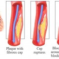 CAD Mi-yocardial-Infarction1