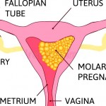 td molar-pregnancy-abnormal-form-pregnancy-many-tdrapes-uterine-cavity-human-realistic-uterus-anatomy-illustration-colored-image-177432565