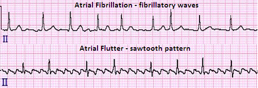 afl atrial_fibrillation
