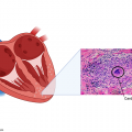 sarc Pauley_Cardiac Granuloma