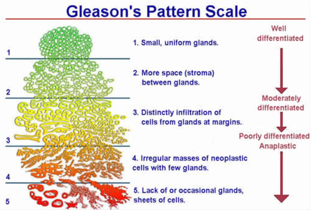 Gleason -pattern-scale-1024x692